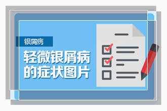 大家了解一些引发牛皮癣的原因有哪些吗