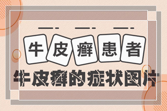 怎么能够判定自己有没有脓疱型银屑病以及相关症状