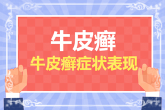 得了皮肤癣（牛皮癣）怎么办？3大应对措施教你如何治疗牛皮癣