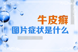 牛皮肤癣发病原因分析：体内3种激素分泌异常，或可导致银屑病发作