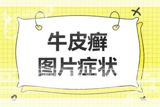 寻常型银屑病并不可怕-对症治疗有哪3点不同？