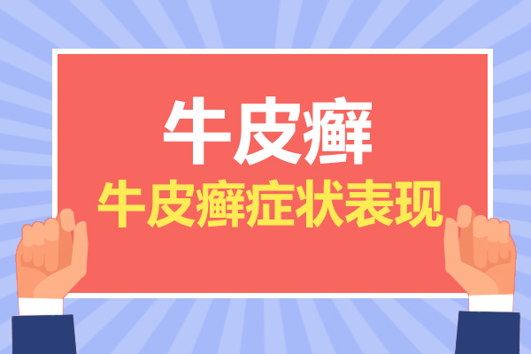 银屑病的饮食治疗需要注意什么?这4点规则不遵守就是在“养病”!