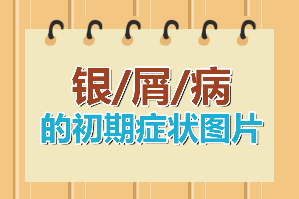 治疗牛皮癣需要多少钱呢-科学治疗牛皮癣，让你少花冤枉钱！